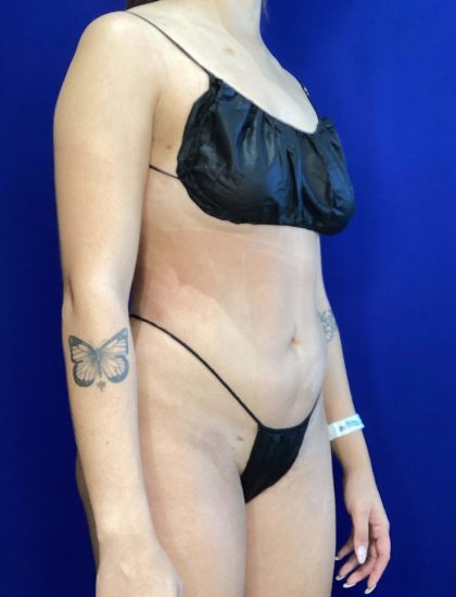 Liposuction Before & After Patient #822