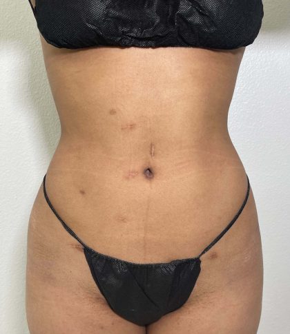 Liposuction Before & After Patient #858