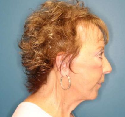Facelift Before & After Patient #596