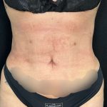 Liposuction Before & After Patient #761