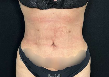 Liposuction Before & After Patient #761