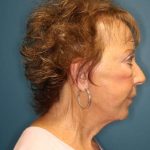 Facelift Before & After Patient #596