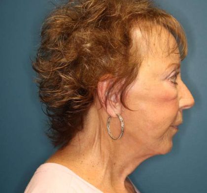 Facelift Before & After Patient #596