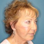 Facelift Before & After Patient #596
