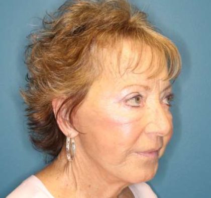 Facelift Before & After Patient #596
