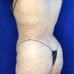 Liposuction Before & After Patient #809