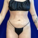 Liposuction Before & After Patient #822