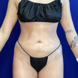 Liposuction Before & After Patient #822