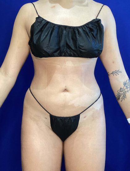 Liposuction Before & After Patient #822