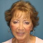 Facelift Before & After Patient #596