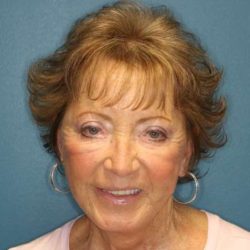 Facelift Before & After Patient #596