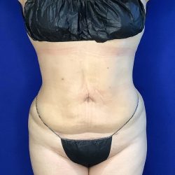 Liposuction Before & After Patient #809