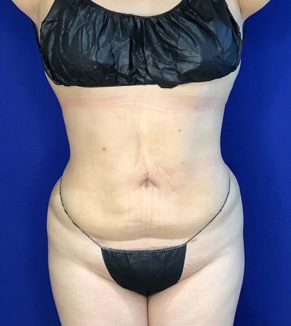 Liposuction Before & After Patient #809