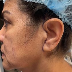 Facelift Before & After Patient #638