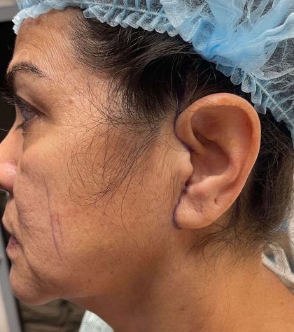 Facelift Before & After Patient #638