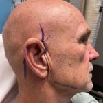 Facelift Before & After Patient #635