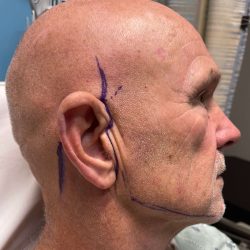 Facelift Before & After Patient #635