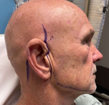 Facelift Before & After Patient #635