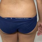 Brazilian Butt Lift Before & After Patient #563