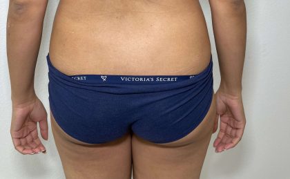 Brazilian Butt Lift Before & After Patient #563