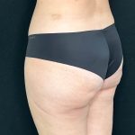 Brazilian Butt Lift Before & After Patient #557
