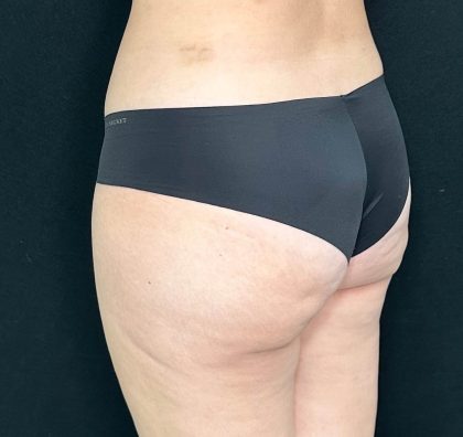 Brazilian Butt Lift Before & After Patient #557