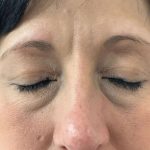 Eyelid Lift Before & After Patient #602