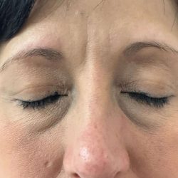 Eyelid Lift Before & After Patient #602