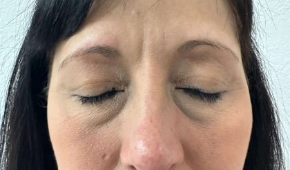 Eyelid Lift Before & After Patient #602