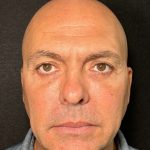 Eyelid Lift Before & After Patient #605