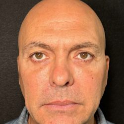 Eyelid Lift Before & After Patient #605