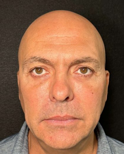 Eyelid Lift Before & After Patient #605