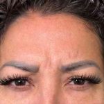 Botox Before & After Patient #534
