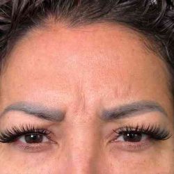 Botox Before & After Patient #534