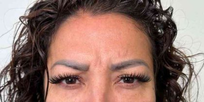 Botox Before & After Patient #534