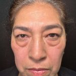 Eyelid Lift Before & After Patient #611