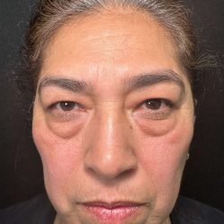 Eyelid Lift Before & After Patient #611