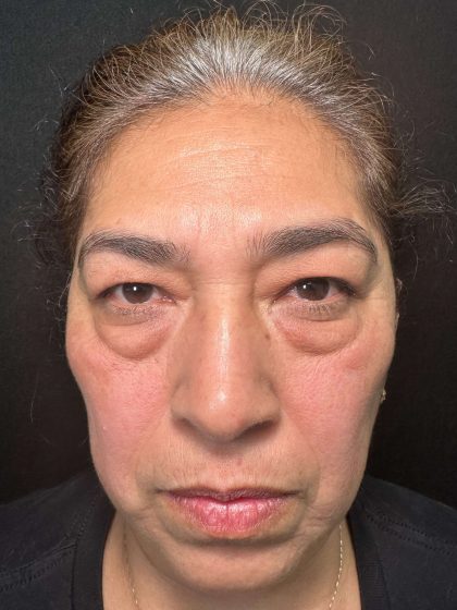 Eyelid Lift Before & After Patient #611