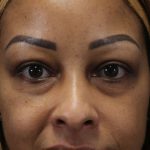 Eyelid Lift Before & After Patient #617