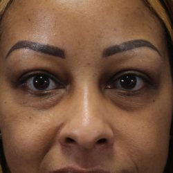 Eyelid Lift Before & After Patient #617