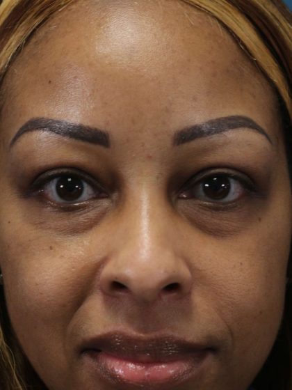 Eyelid Lift Before & After Patient #617