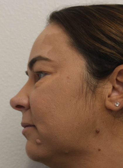 Eyelid Lift Before & After Patient #632