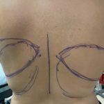 Liposuction Before & After Patient #844