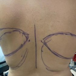 Liposuction Before & After Patient #844