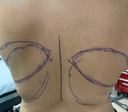 Liposuction Before & After Patient #844