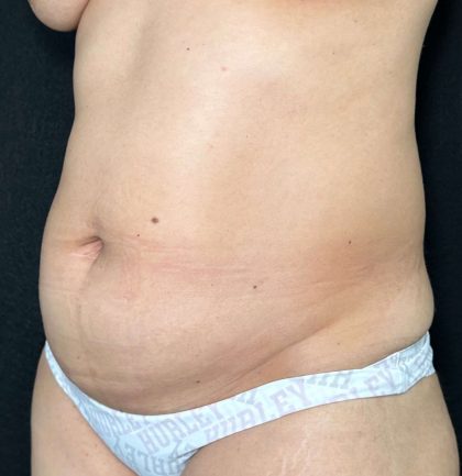 Tummy Tuck Before & After Patient #907