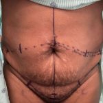 Tummy Tuck Before & After Patient #918