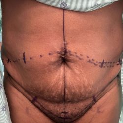 Tummy Tuck Before & After Patient #918