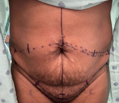 Tummy Tuck Before & After Patient #918
