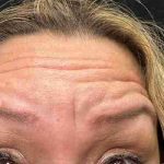Botox Before & After Patient #537
